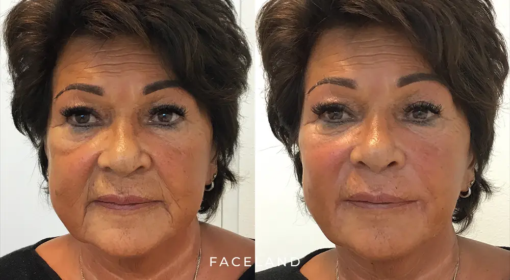 Liquid facelift