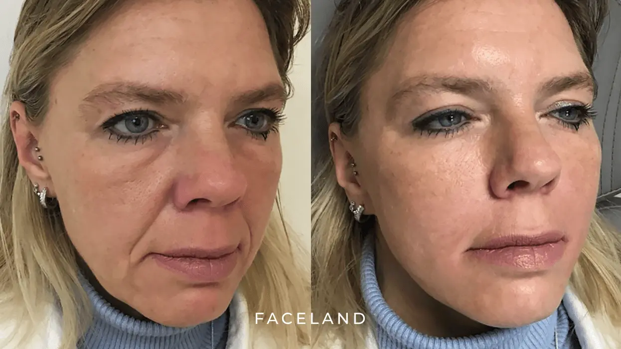 Liquid Facelift