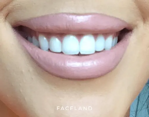 Gummy smile resultaat