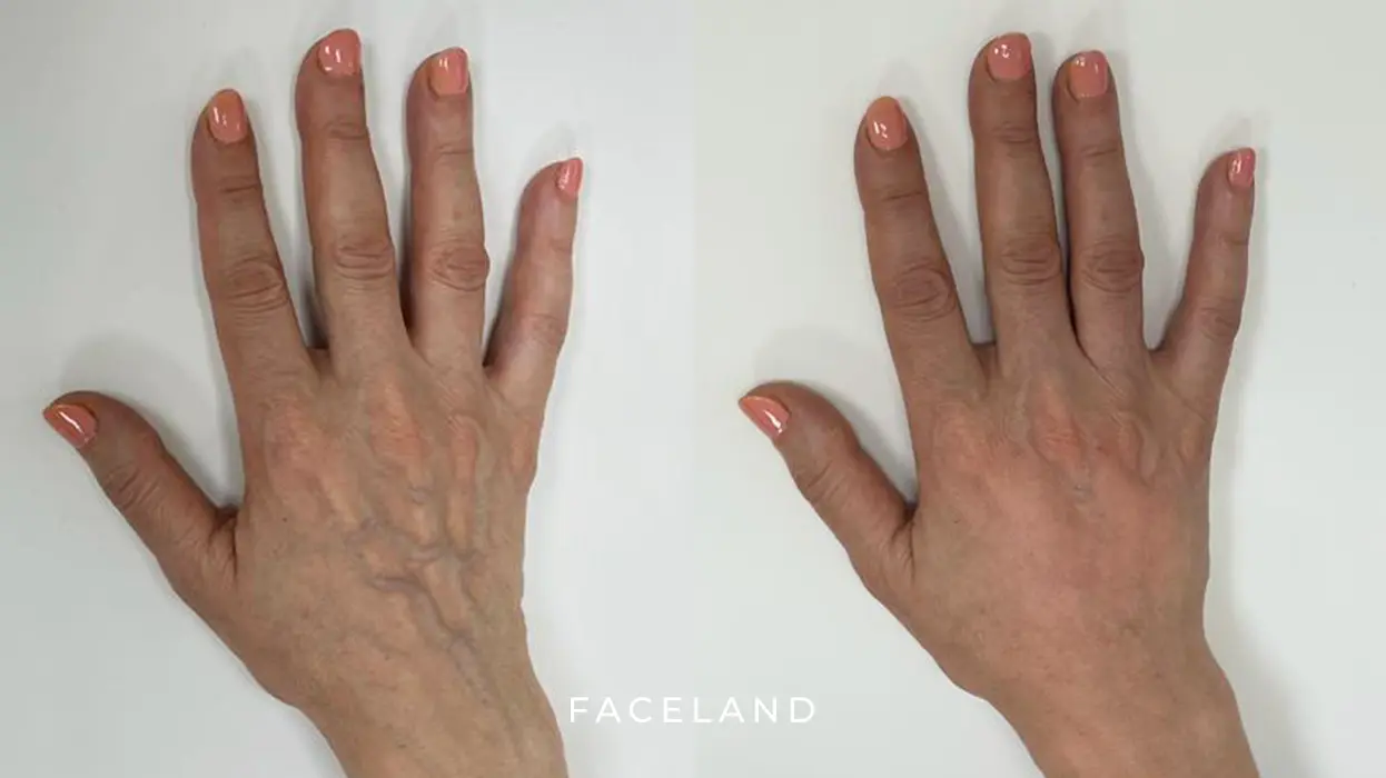 Reductor In tegenspraak Delegeren Last van 'oude handen'? | Handverjonging | Faceland - Face your beauty