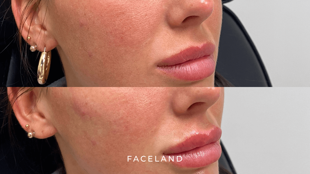 Wat zijn jukbeenderen fillers? 