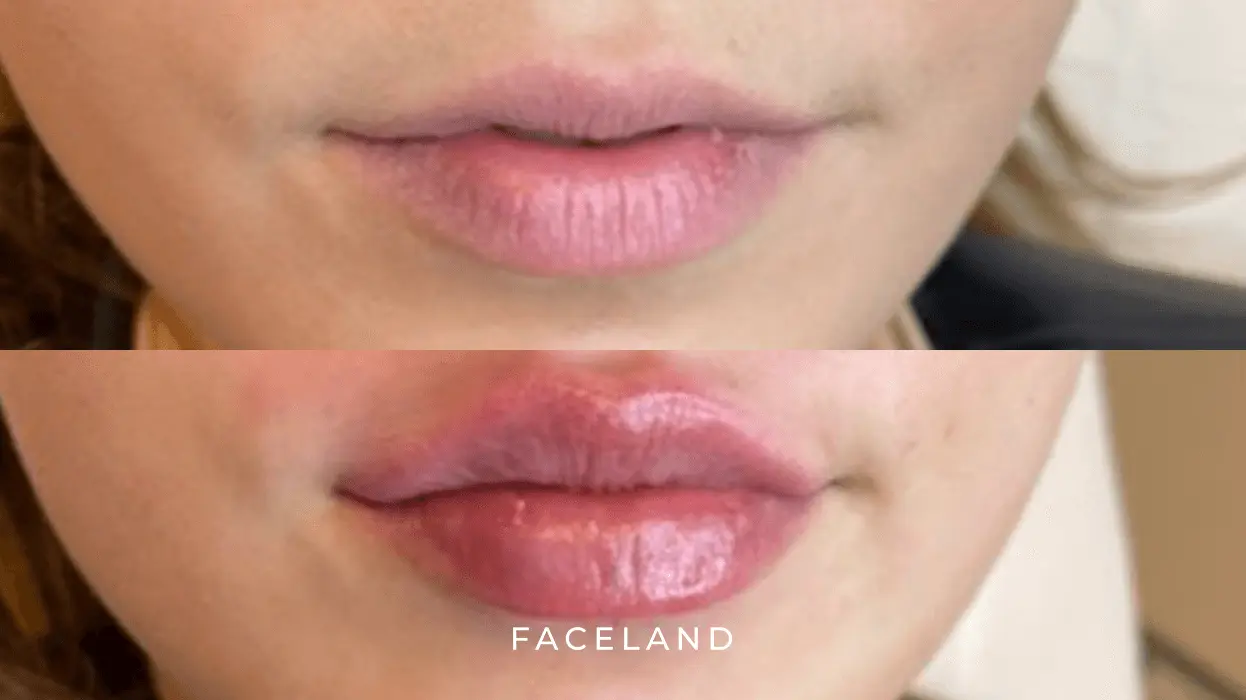Hyaluronzuur fillers