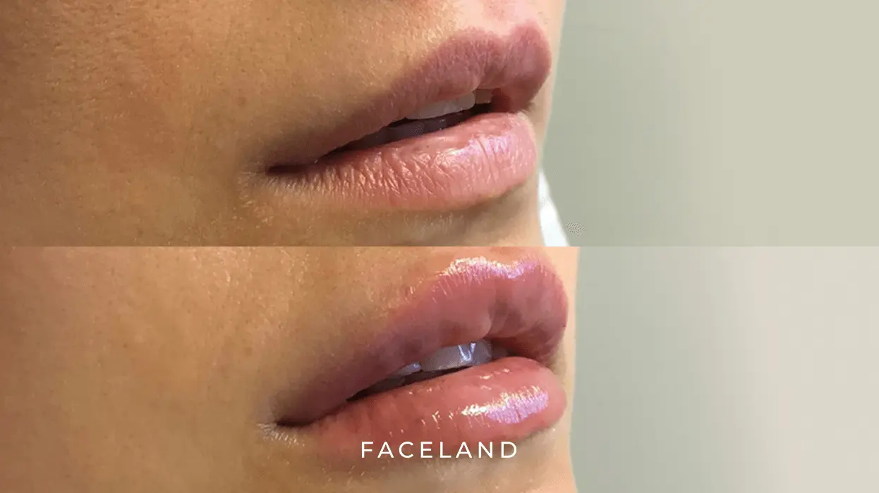 Lip fillers resultaat