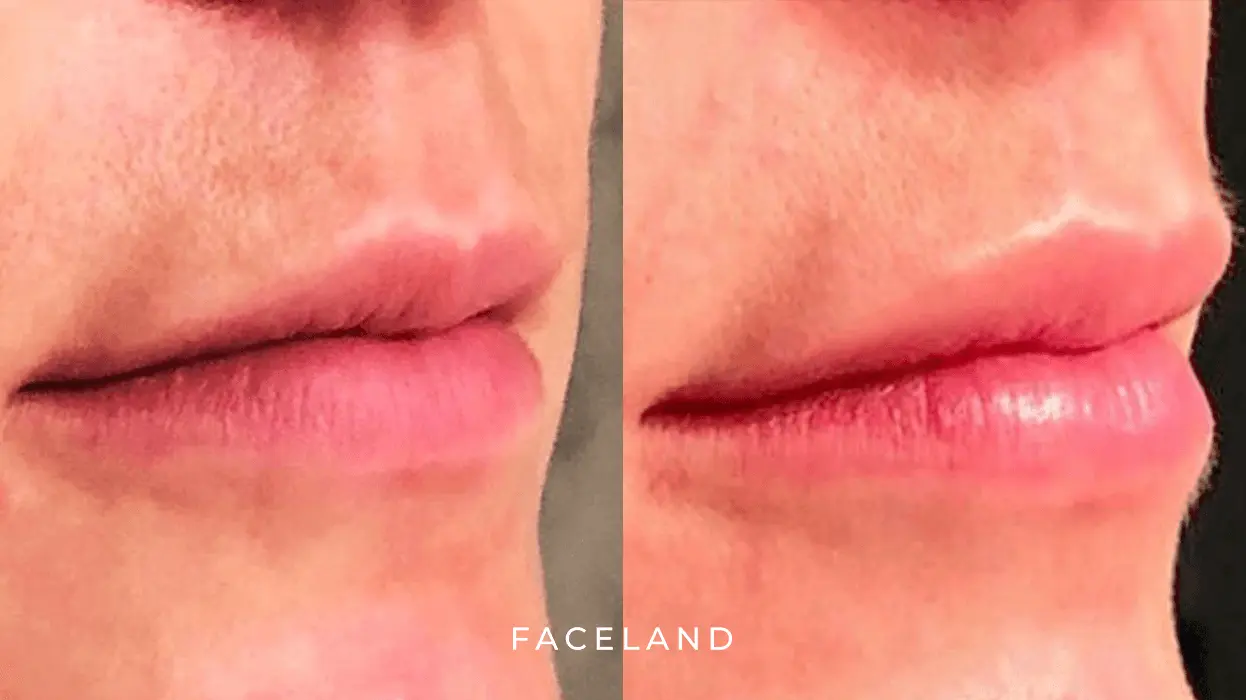 Lip flip before and after