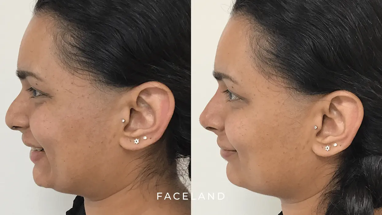 Neus fillers before and after
