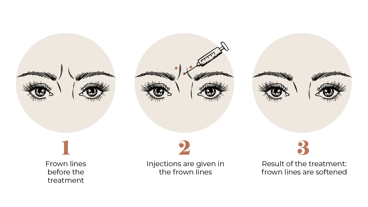 Frown Lines
