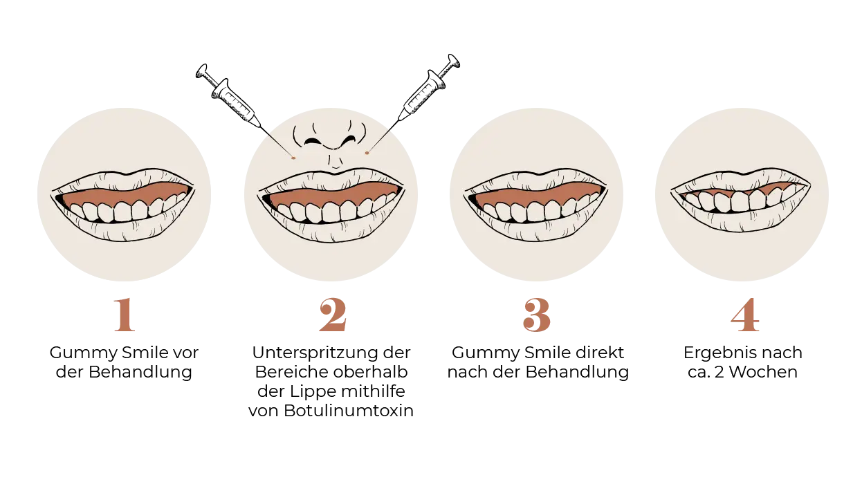 Gummy Smile