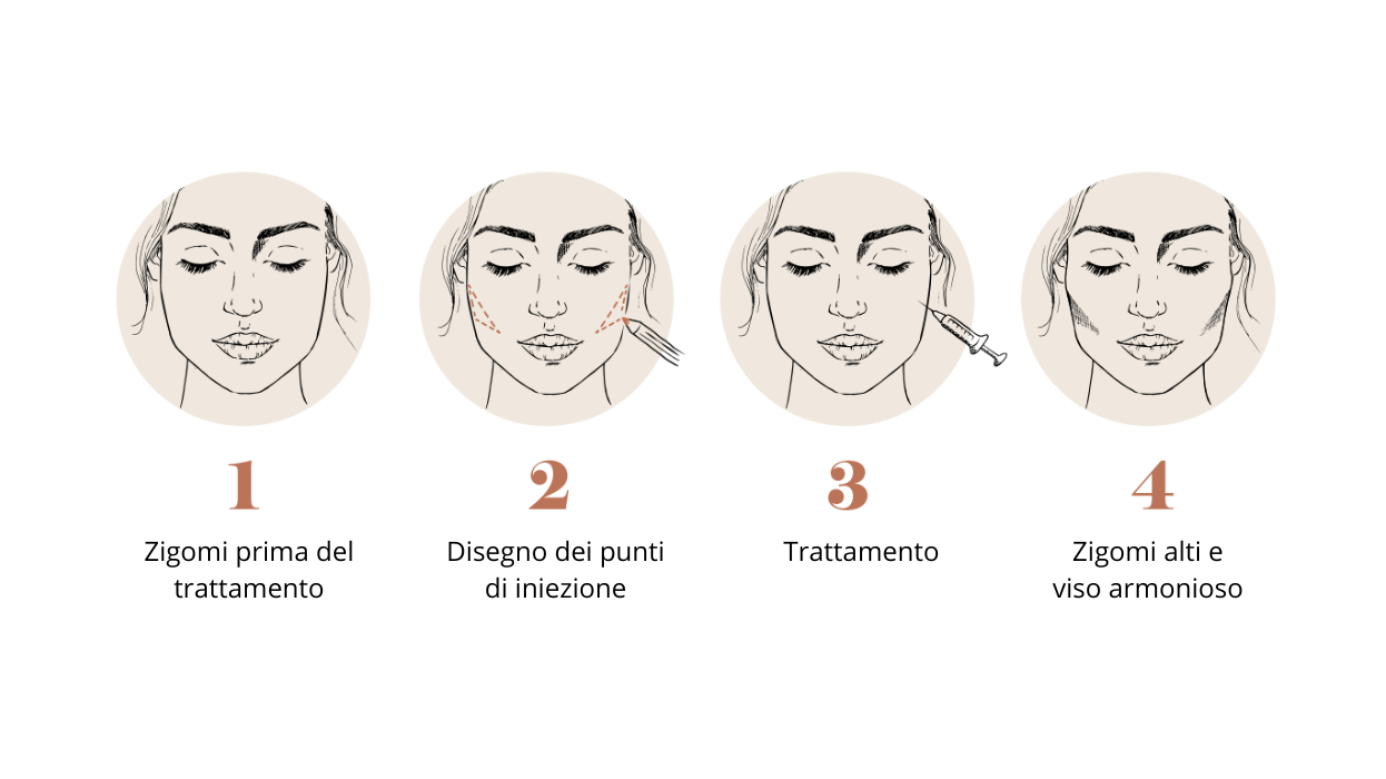Filler zigomi