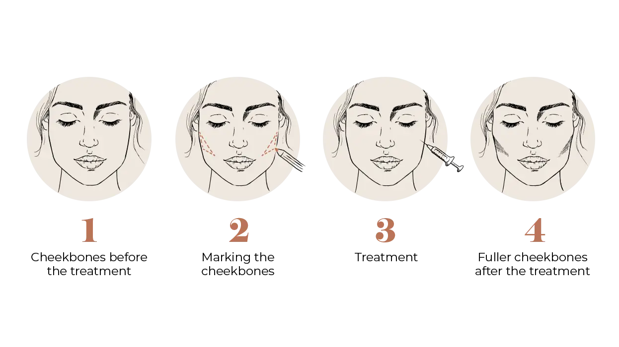 Cheekbone Fillers