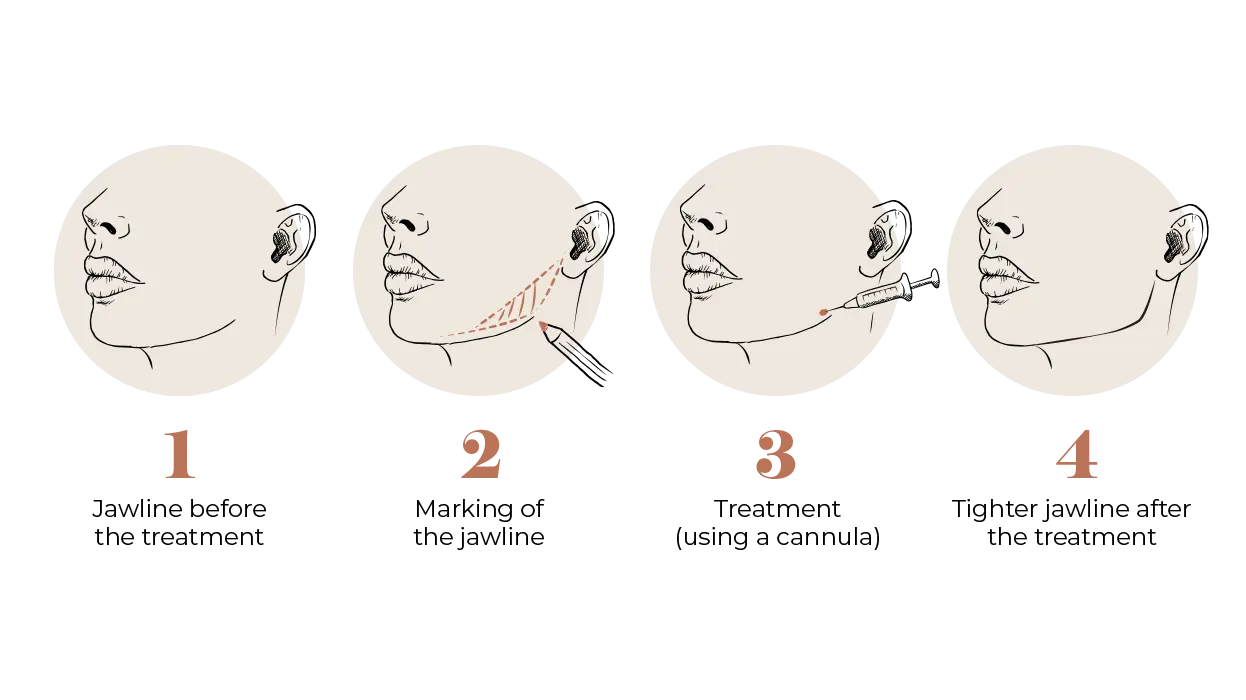 Jawline Fillers