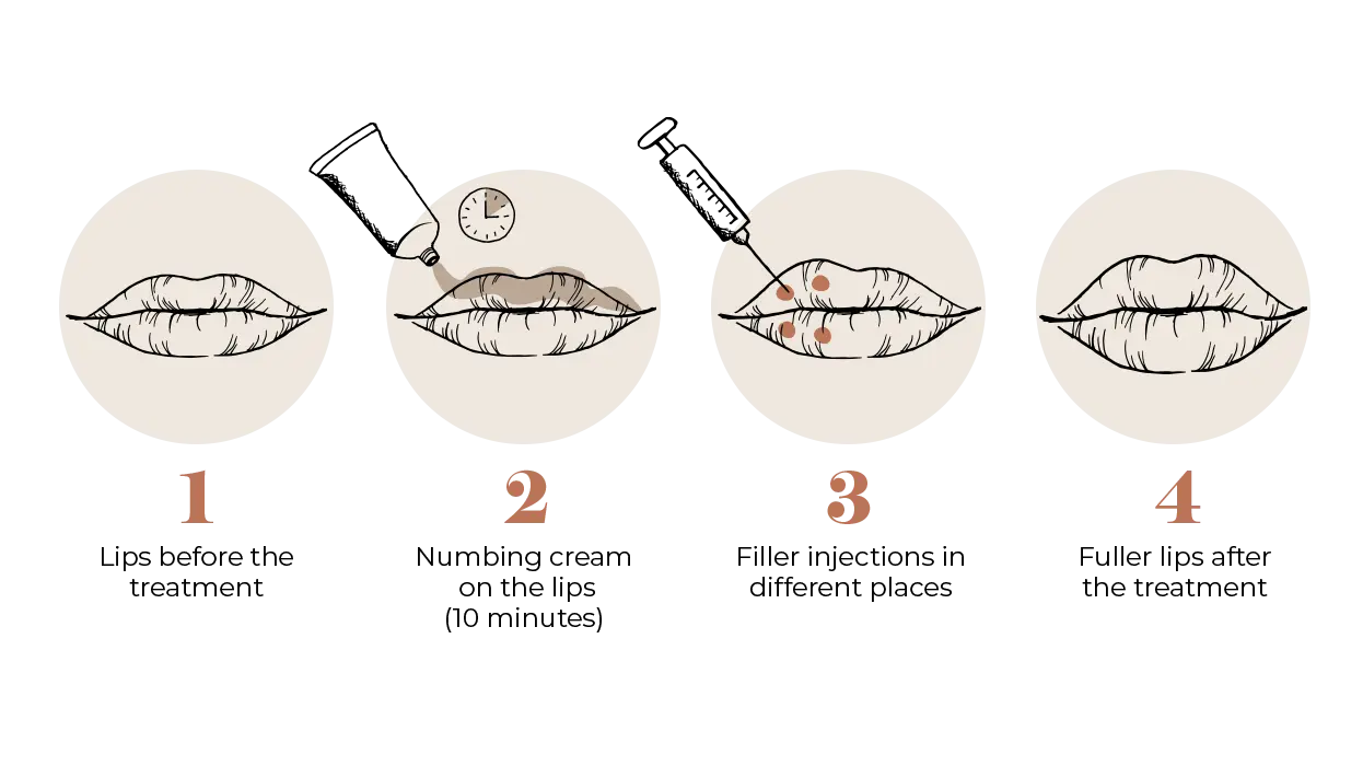Lip Fillers