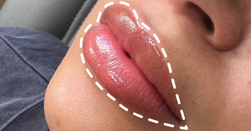 Que sont les Lip Flip?