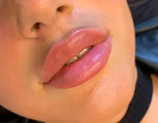 Lippen aufspritzen Ergebnis