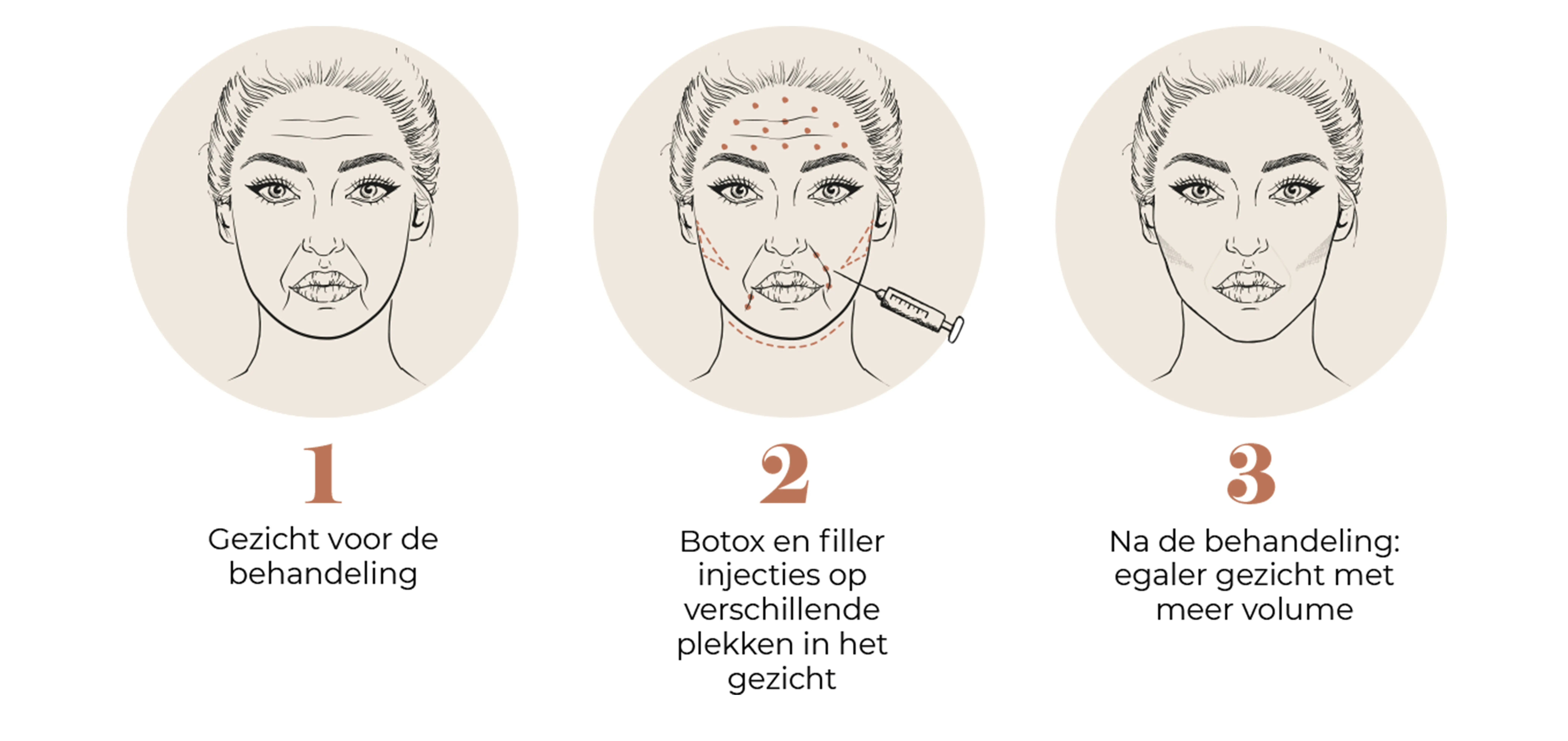 Fillers en spierontspanners: de perfecte combinatie