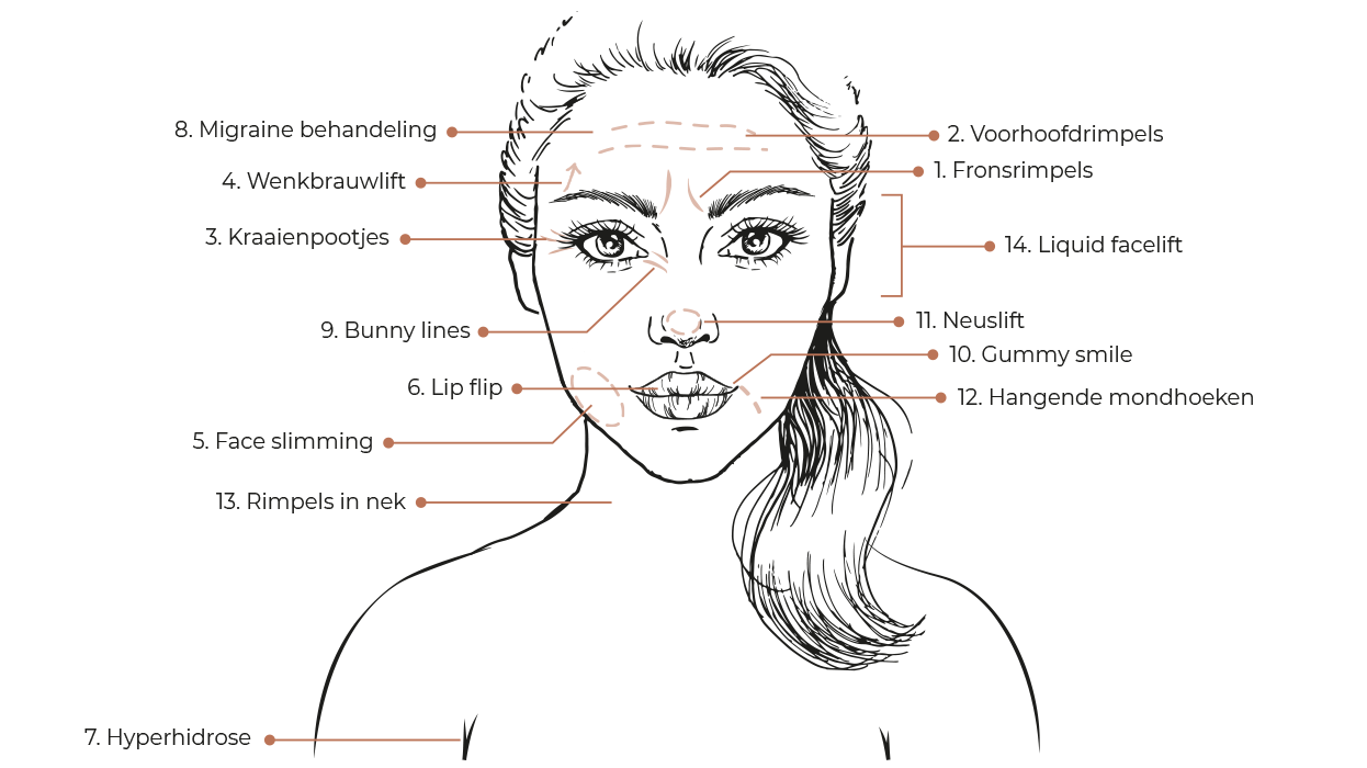Welke spierontspanner zones zijn er?