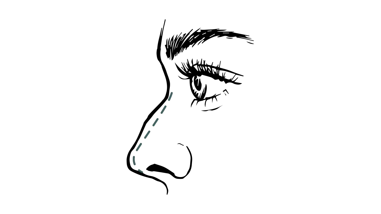 Neuscorrectie resultaat