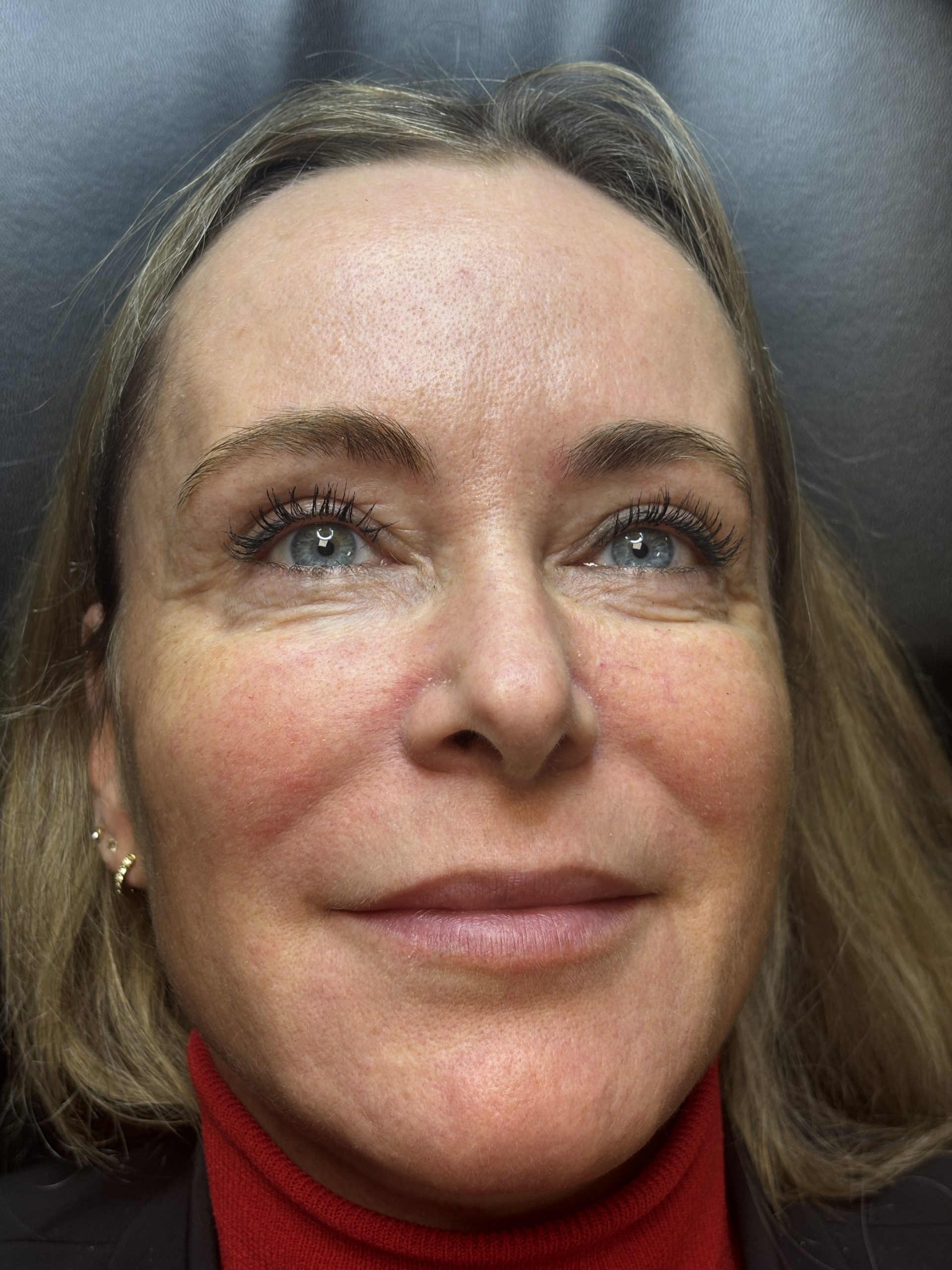 Wat is een wenkbrauwlift?