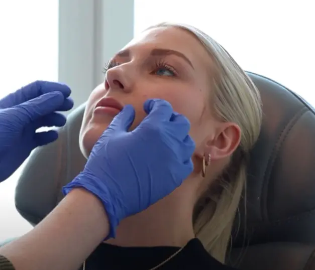 Een natuurlijk vollere glimlach: Milou’s lip filler ervaring