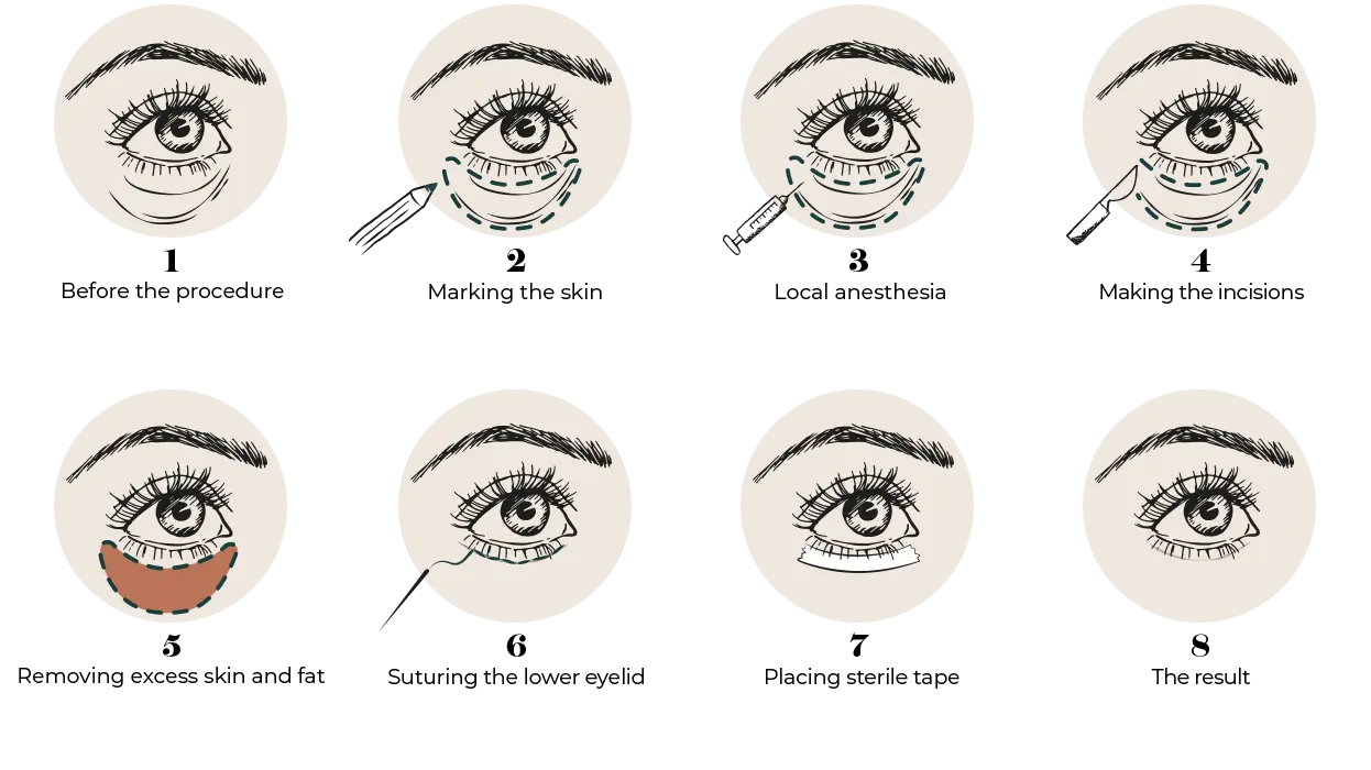 Lower Eyelid Surgery