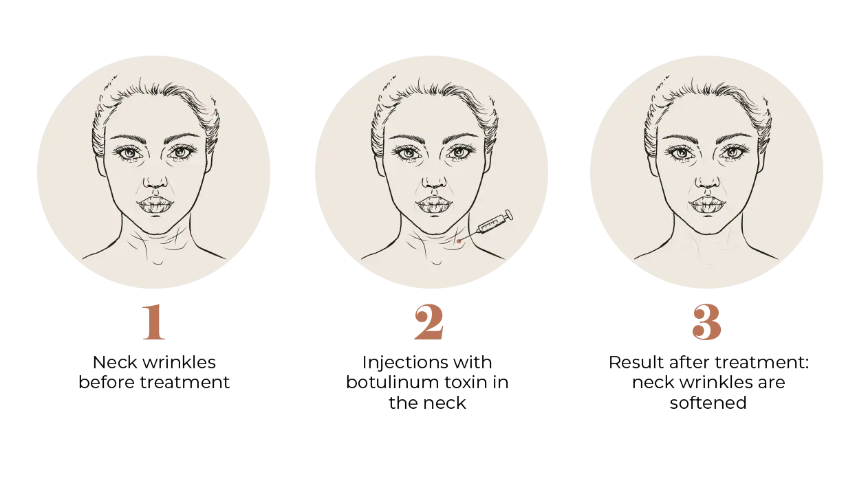 Neck Wrinkle Treatment