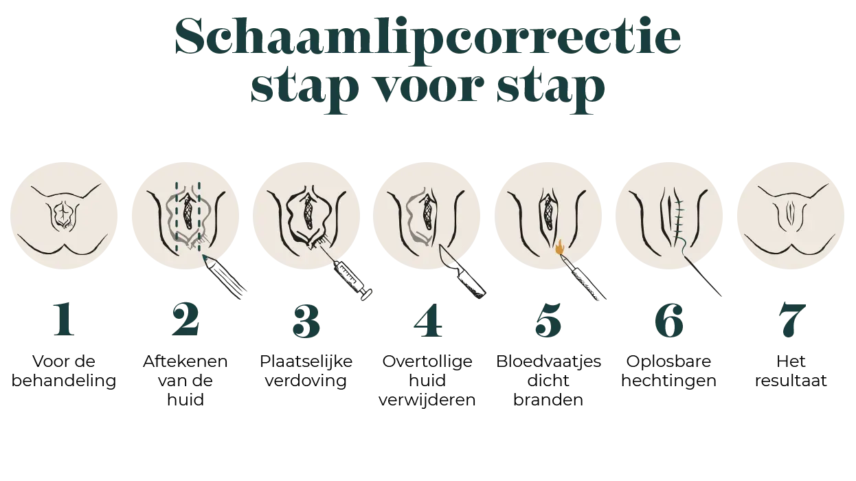 Schaamlipcorrectie stap voor stap