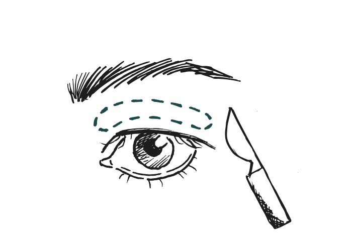 Gemma vloog naar Nederland voor een bovenooglidcorrectie bij Faceland