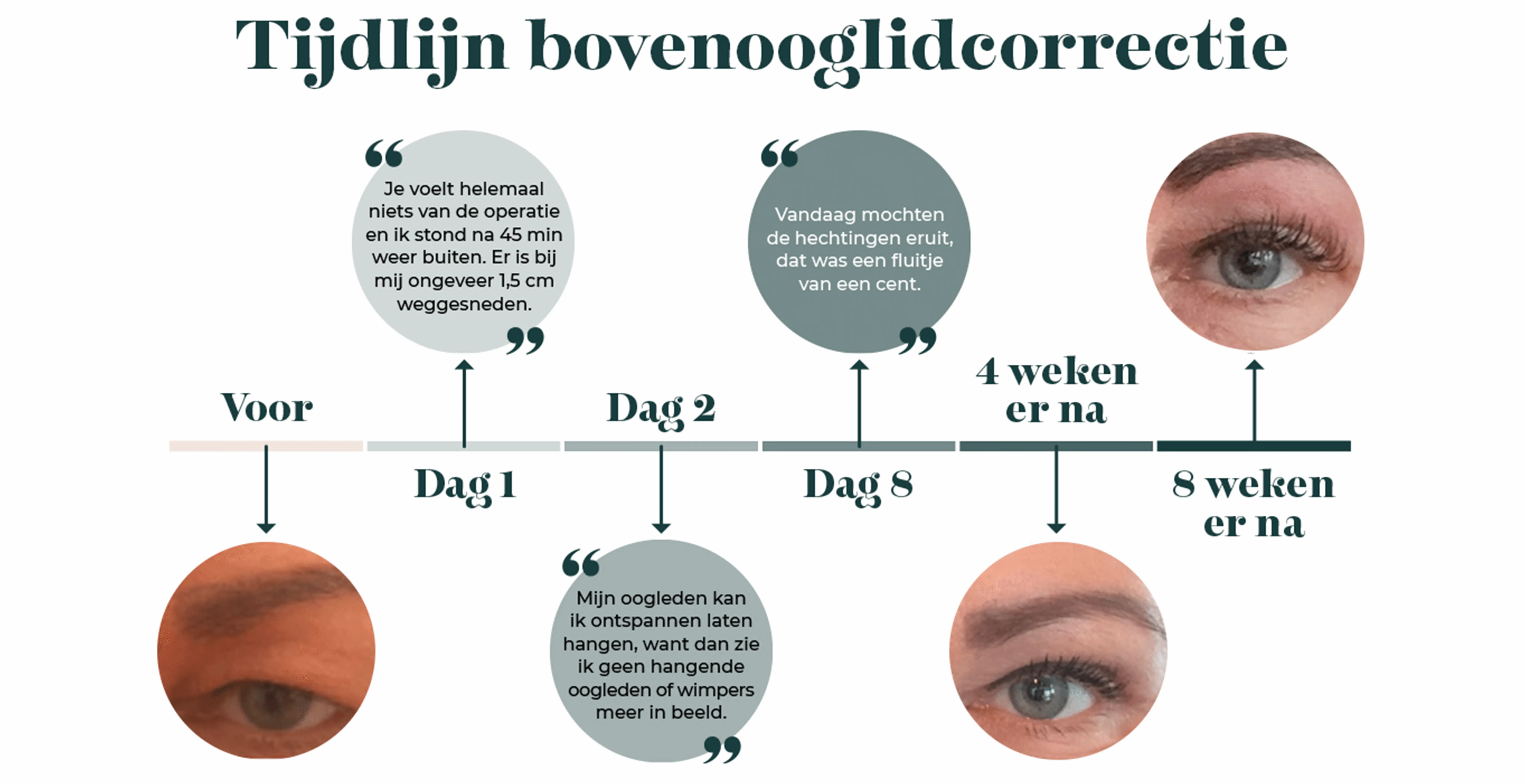 Welke oog operatie past bij mij?