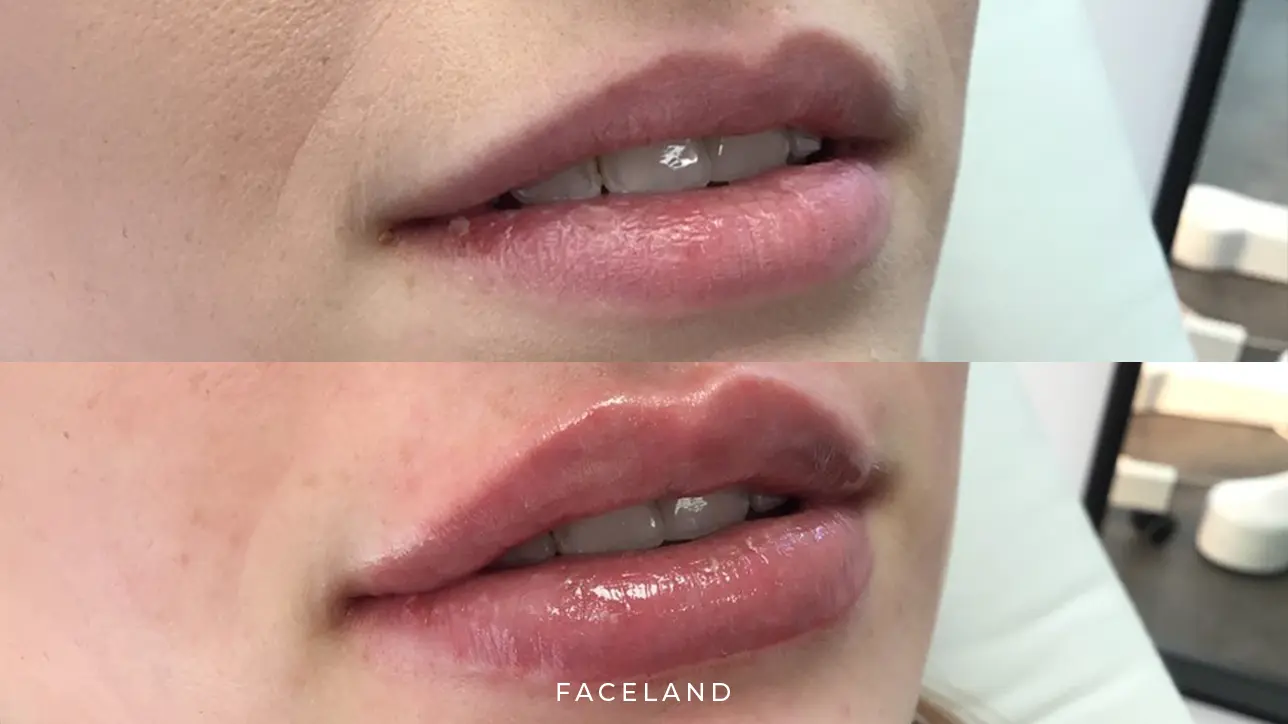 Lip fillers voor en na