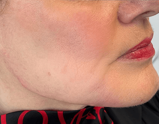 Wat zijn ingevallen wangen?