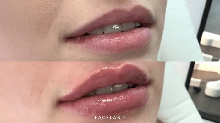 Lip fillers bij Faceland: The Russian Method