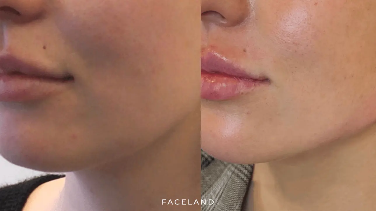 Jawline Filler