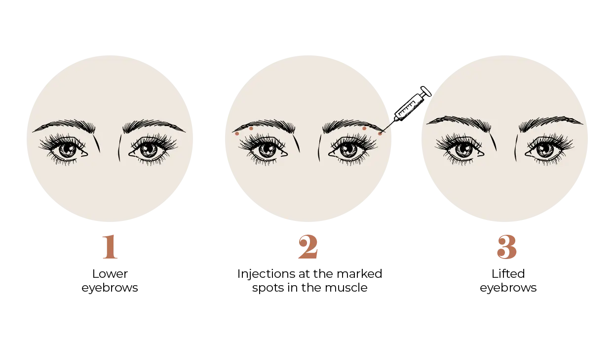 Eyebrow Lift